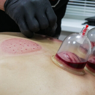 Wet Cupping Therapy